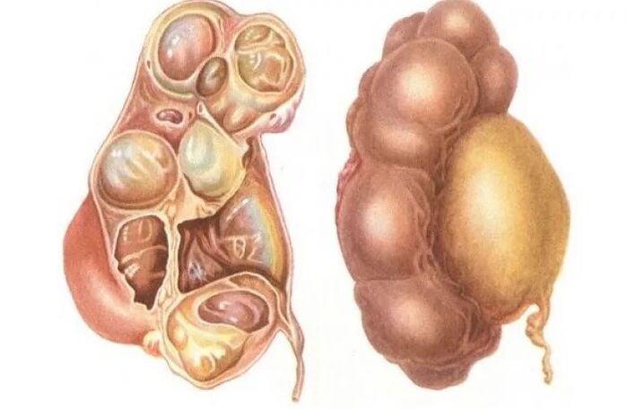 Vesiculita