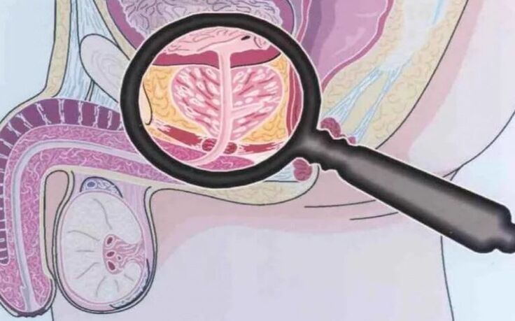 Prostatite crónica
